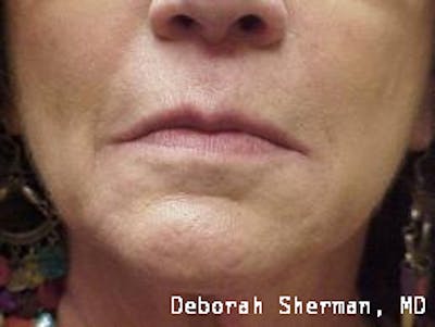 Restylane Silk Before & After Gallery - Patient 215660 - Image 1