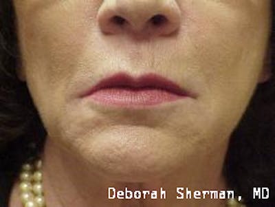 Restylane Silk Before & After Gallery - Patient 215660 - Image 2