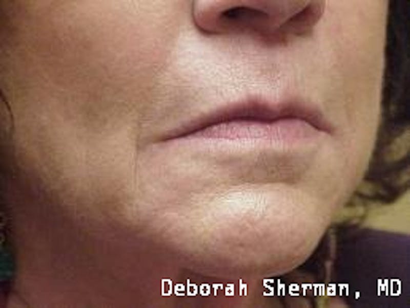 Restylane Silk Before & After Gallery - Patient 215660 - Image 5