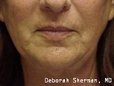 Restylane Silk Before & After Gallery - Patient 193840 - Image 1