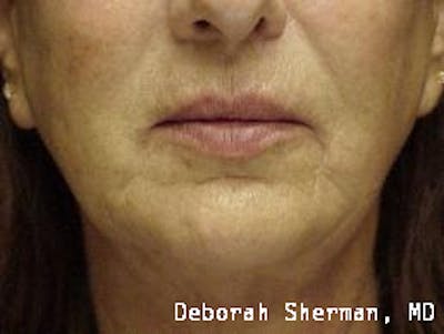 Restylane Silk Before & After Gallery - Patient 193840 - Image 2