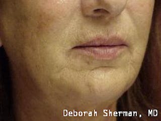 Restylane Silk Before & After Gallery - Patient 193840 - Image 4