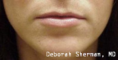 Restylane Silk Before & After Gallery - Patient 158905 - Image 1