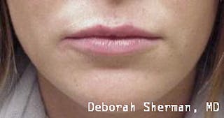 Restylane Silk Before & After Gallery - Patient 158905 - Image 2