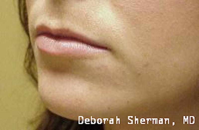 Restylane Silk Before & After Gallery - Patient 158905 - Image 3