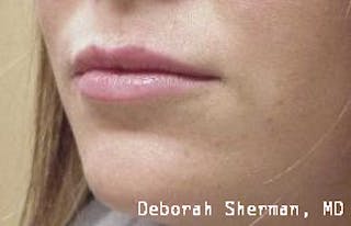 Restylane Silk Before & After Gallery - Patient 158905 - Image 4