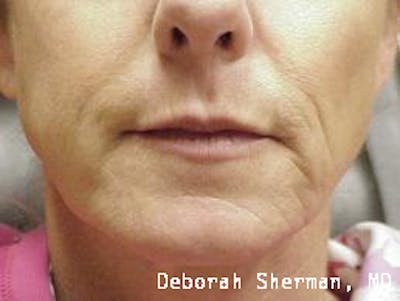 Restylane Silk Before & After Gallery - Patient 476728 - Image 1