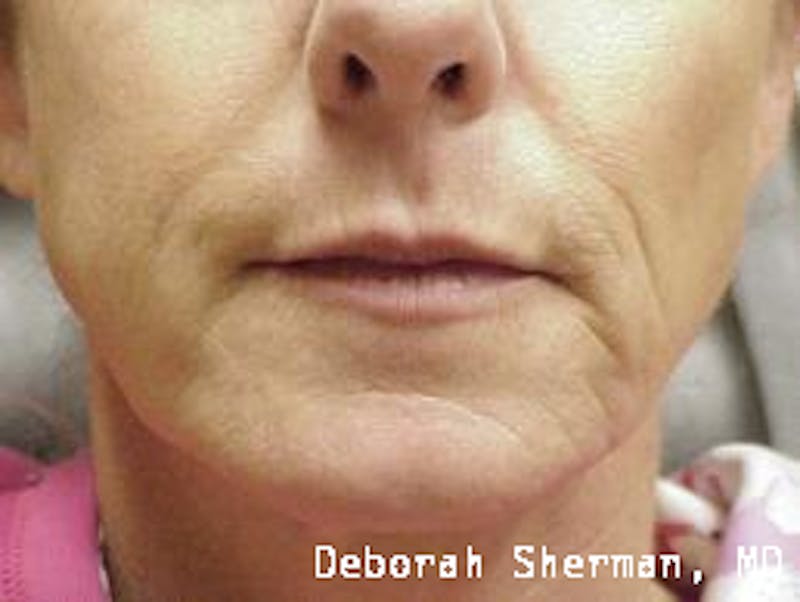 Restylane Silk Before & After Gallery - Patient 476728 - Image 1