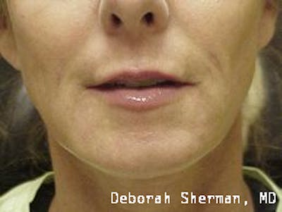 Restylane Silk Before & After Gallery - Patient 476728 - Image 2
