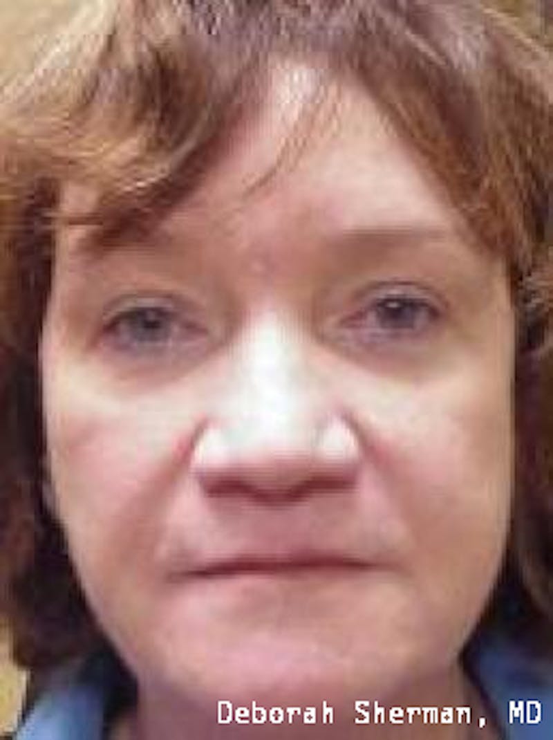 Juvederm® Before & After Gallery - Patient 243063 - Image 1