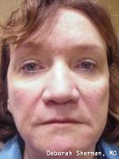 Juvederm® Before & After Gallery - Patient 243063 - Image 2
