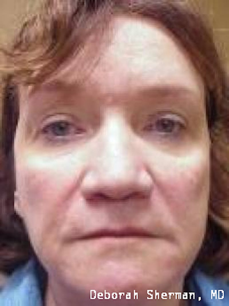 Juvederm® Before & After Gallery - Patient 243063 - Image 2