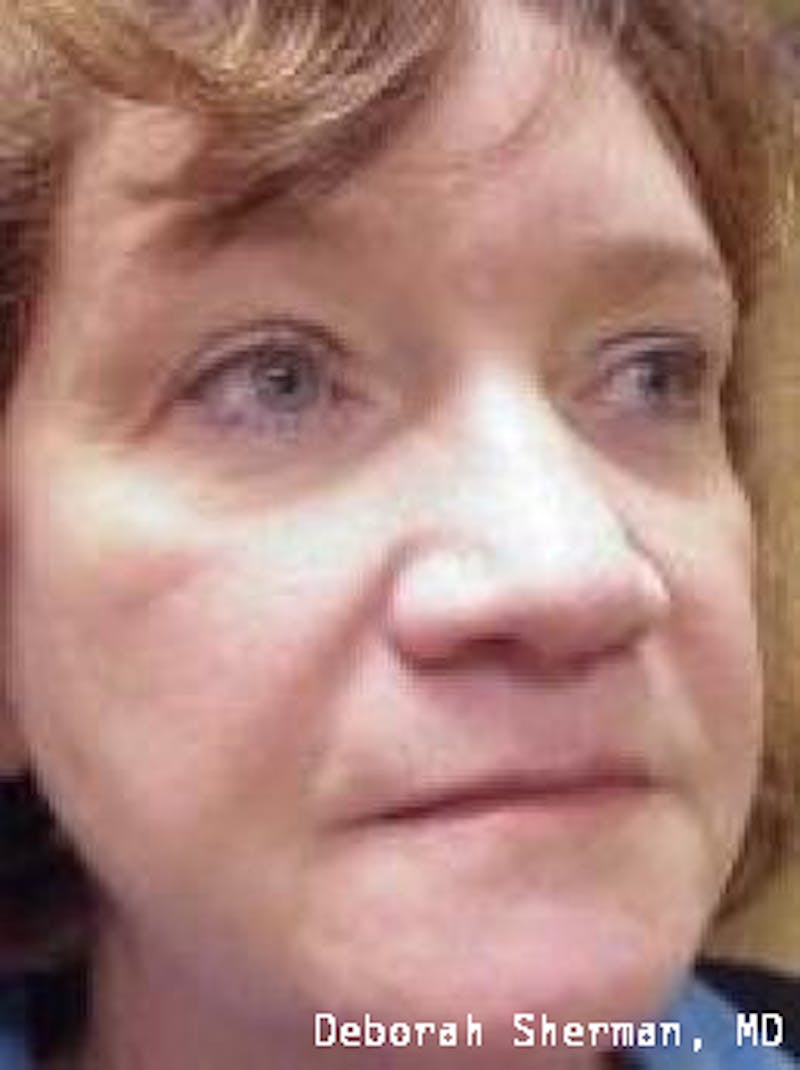 Juvederm® Before & After Gallery - Patient 243063 - Image 3
