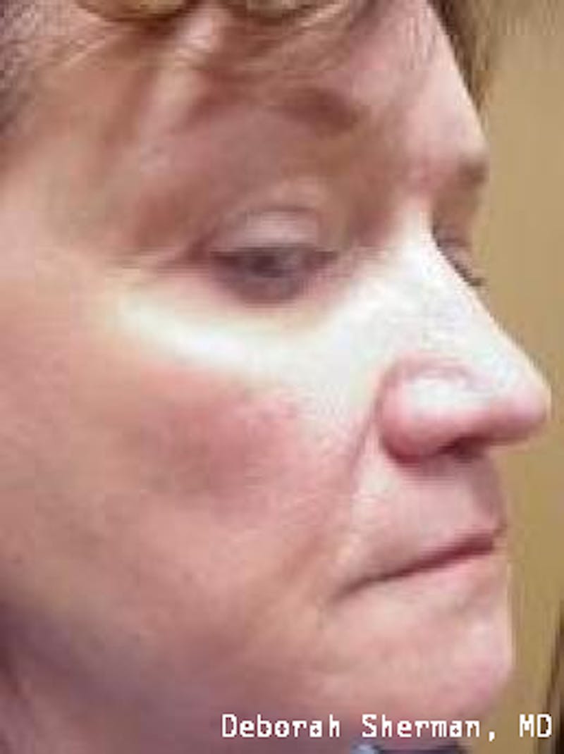 Juvederm® Before & After Gallery - Patient 243063 - Image 6