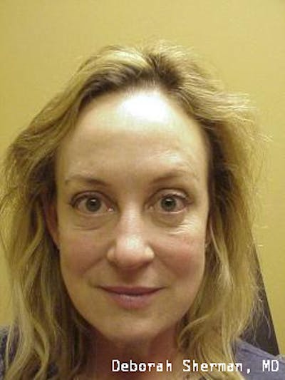 Juvederm® Before & After Gallery - Patient 229278 - Image 1