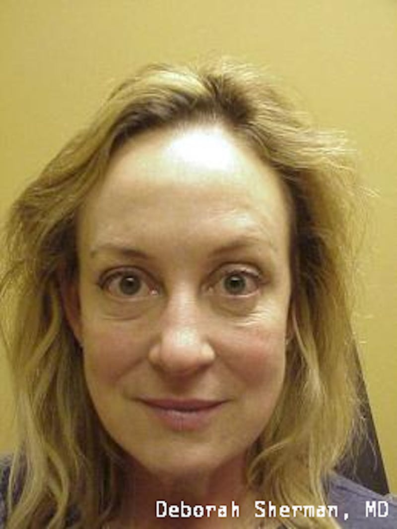 Juvederm® Before & After Gallery - Patient 229278 - Image 1