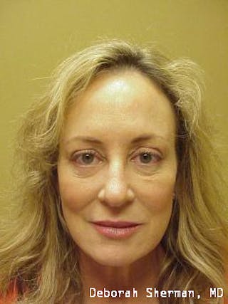 Juvederm® Before & After Gallery - Patient 229278 - Image 2