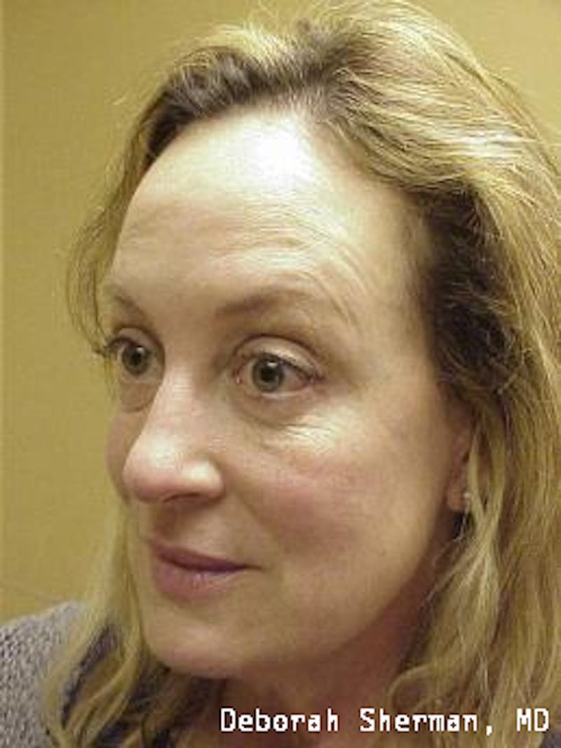 Juvederm® Before & After Gallery - Patient 229278 - Image 3