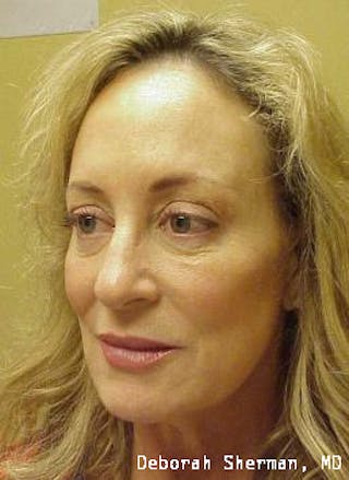 Juvederm® Before & After Gallery - Patient 229278 - Image 4