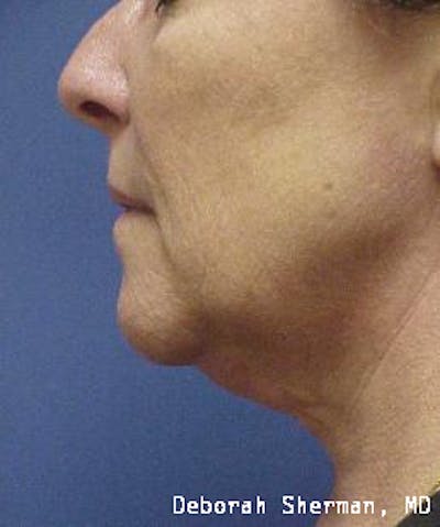 Kybella Before & After Gallery - Patient 253313 - Image 1