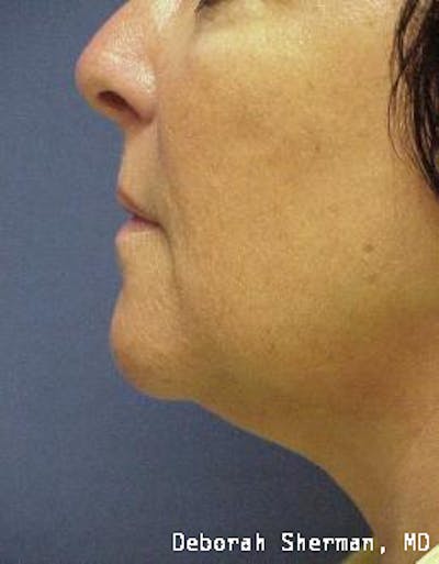 Kybella Before & After Gallery - Patient 253313 - Image 2
