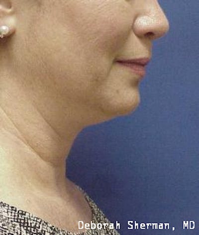 Kybella Before & After Gallery - Patient 398489 - Image 1