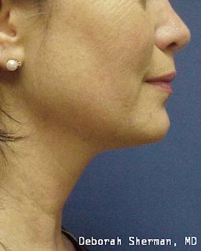 Kybella Before & After Gallery - Patient 398489 - Image 2