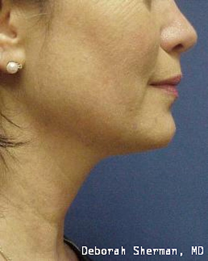 Kybella Before & After Gallery - Patient 398489 - Image 2