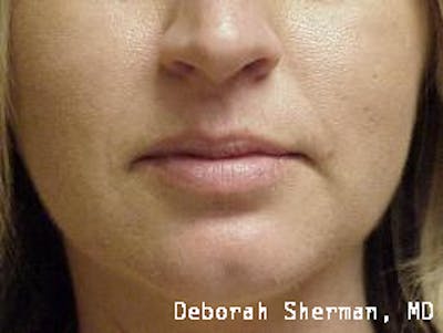 Juvederm® Before & After Gallery - Patient 107354 - Image 1