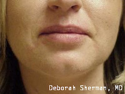Juvederm® Before & After Gallery - Patient 107354 - Image 2