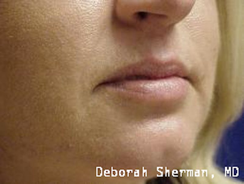 Juvederm® Before & After Gallery - Patient 107354 - Image 3
