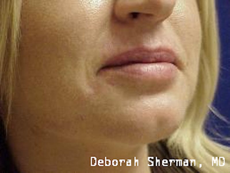 Juvederm® Before & After Gallery - Patient 107354 - Image 4