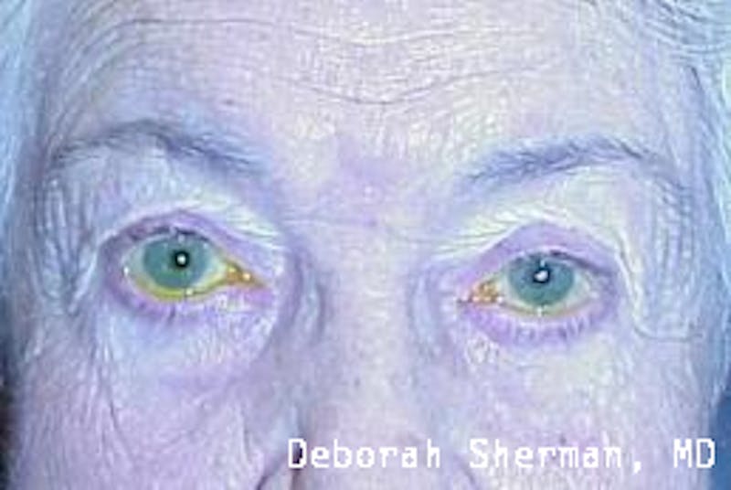 Ectropion Before & After Gallery - Patient 403325 - Image 1