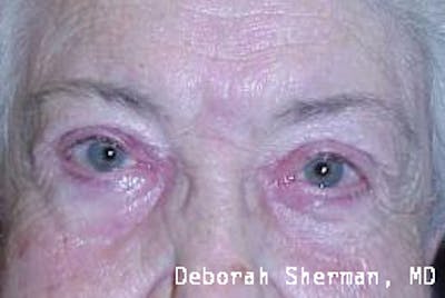 Ectropion Before & After Gallery - Patient 403325 - Image 2