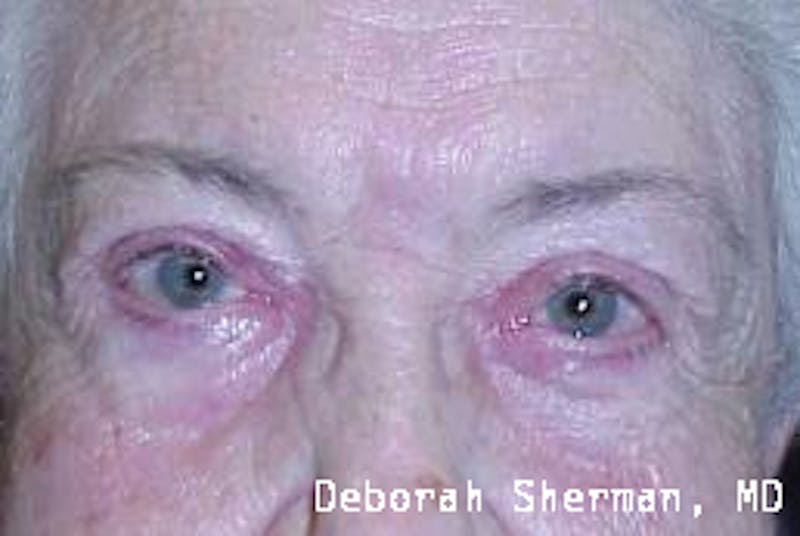 Ectropion Before & After Gallery - Patient 403325 - Image 2