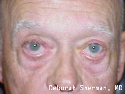 Ectropion Before & After Gallery - Patient 788637 - Image 1