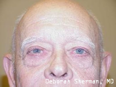 Ectropion Before & After Gallery - Patient 788637 - Image 2