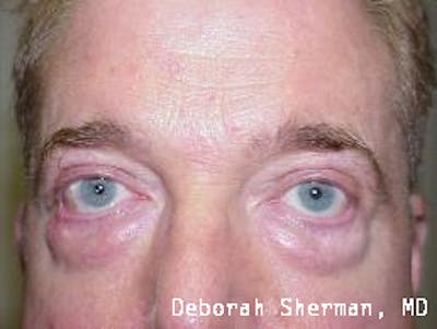 Ectropion Before & After Gallery - Patient 383021 - Image 1