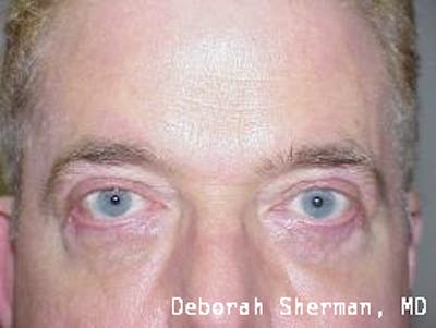 Ectropion Before & After Gallery - Patient 383021 - Image 2