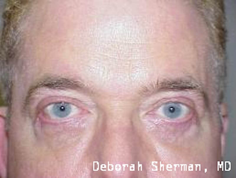 Ectropion Before & After Gallery - Patient 383021 - Image 2