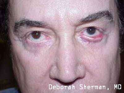 Ectropion Before & After Gallery - Patient 368647 - Image 1