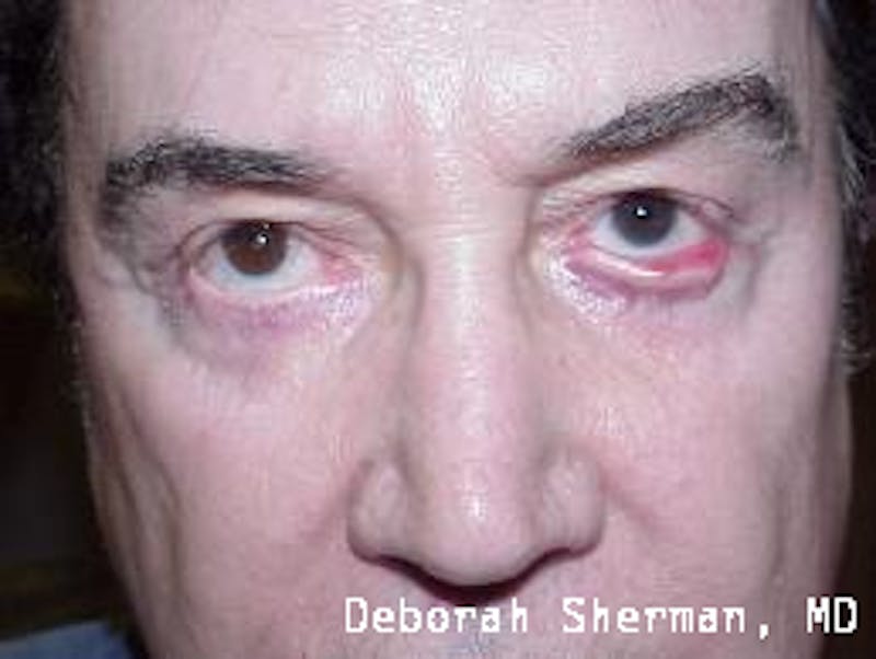 Ectropion Before & After Gallery - Patient 368647 - Image 1