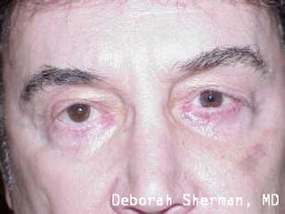 Ectropion Before & After Gallery - Patient 368647 - Image 2