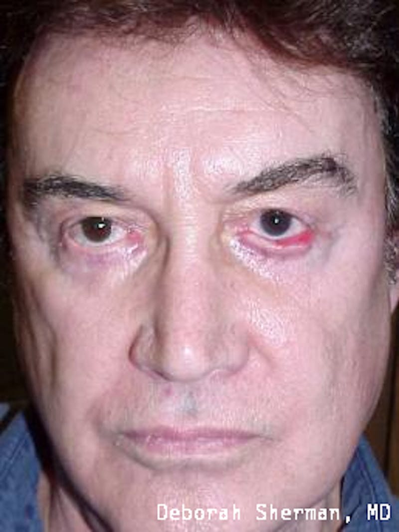 Ectropion Before & After Gallery - Patient 368647 - Image 3