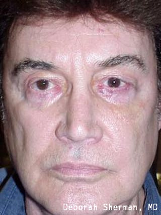 Ectropion Before & After Gallery - Patient 368647 - Image 4