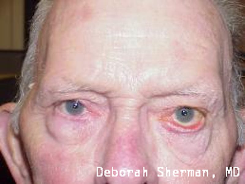 Ectropion Before & After Gallery - Patient 596680 - Image 1
