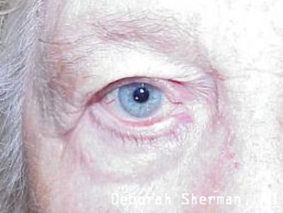 Ectropion Before & After Gallery - Patient 829316 - Image 1
