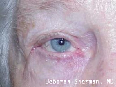 Ectropion Before & After Gallery - Patient 829316 - Image 2