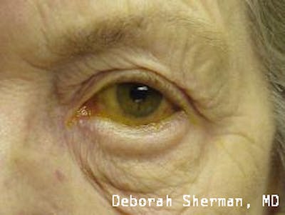 Entropion Before & After Gallery - Patient 916515 - Image 1