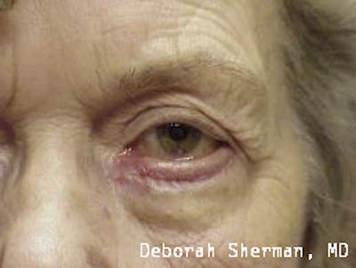 Entropion Before & After Gallery - Patient 916515 - Image 2